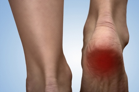 3 Causes of Heel Pain